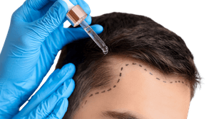 زراعة الشعر