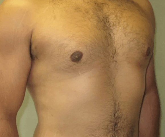 breast after 1 جراحة الثدي عند الرجال