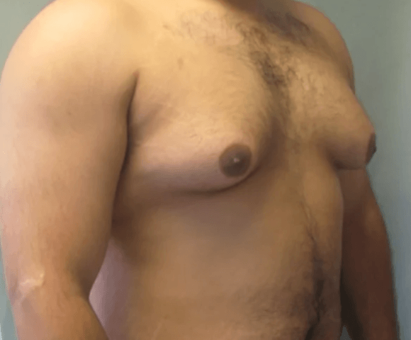 breast before 1 جراحة الثدي عند الرجال