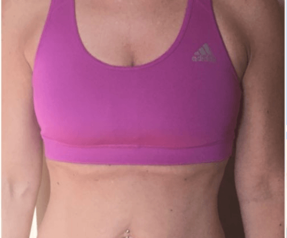 breast before 1