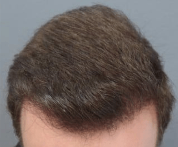 hair after 1