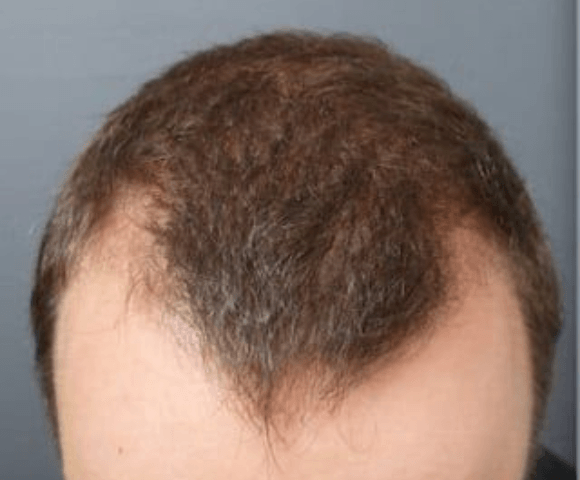hair before 1