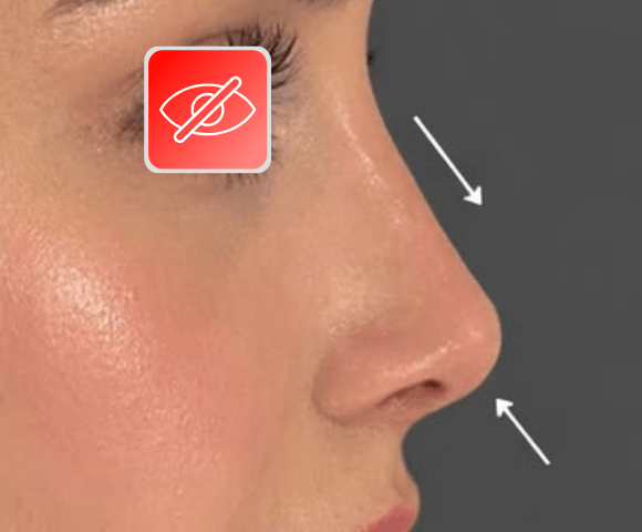 nose after 1