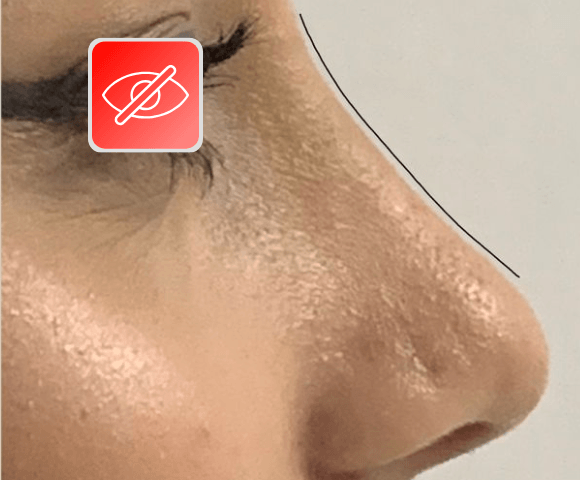 nose after 2