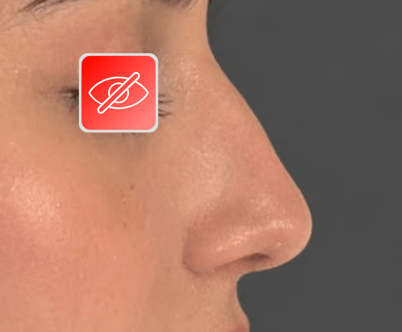 nose before 1