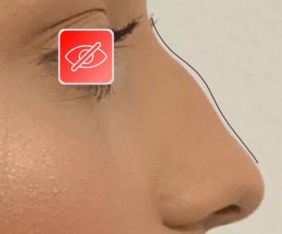 nose before 2